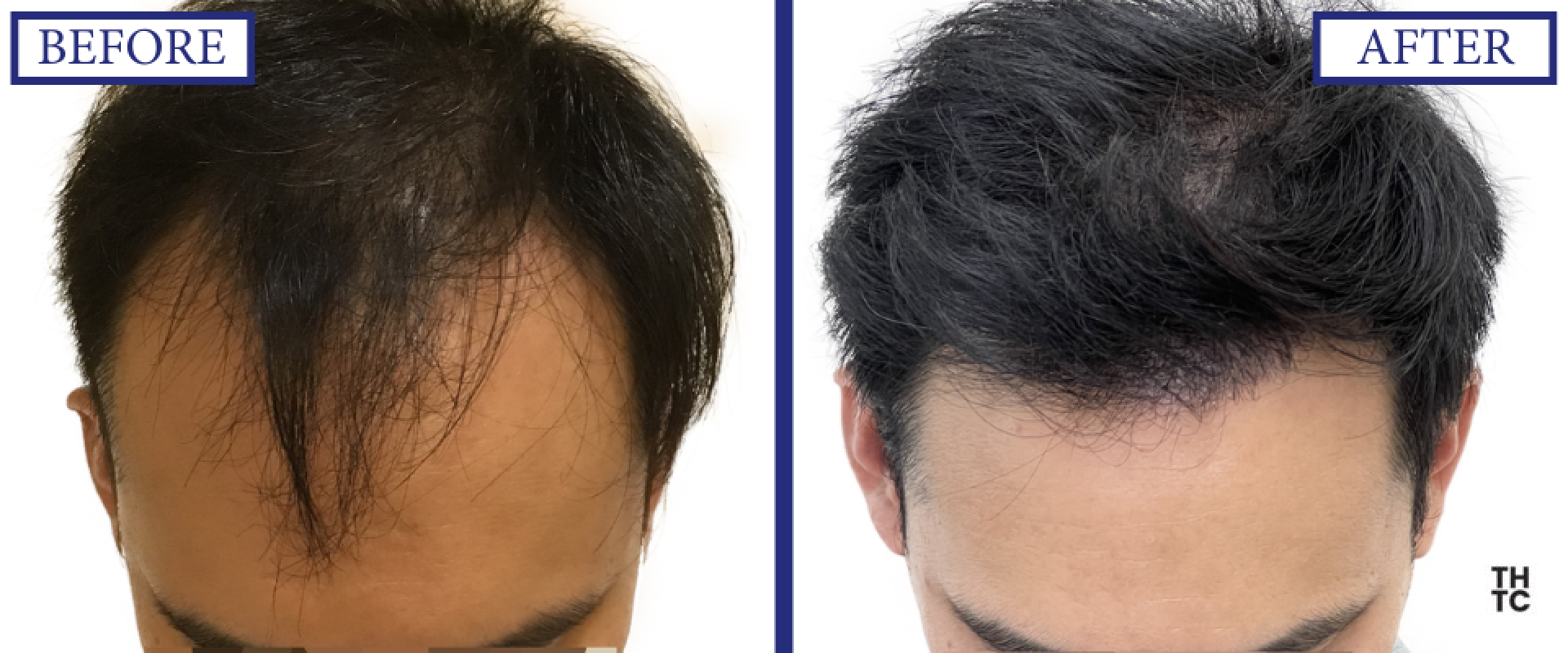Hair Transplant Toronto
